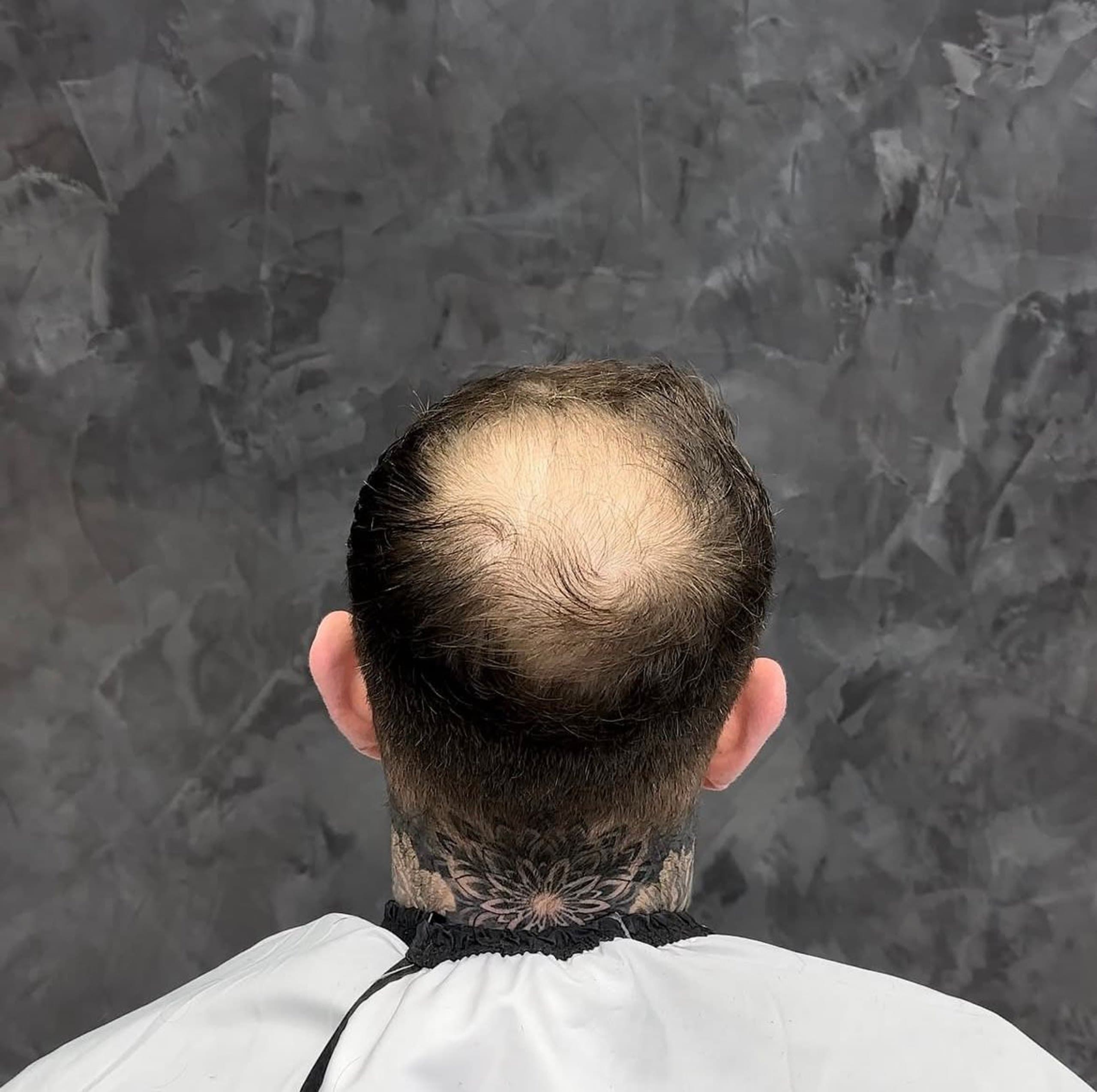 Voor: dunner wordend of kalend haar — resultaat 1