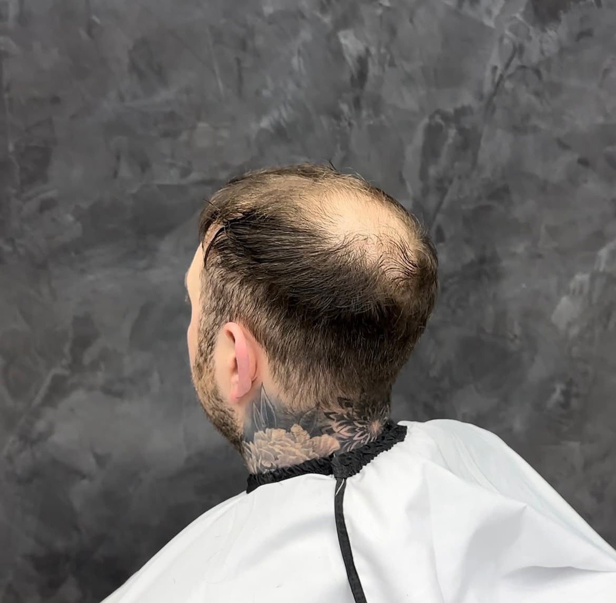 Voor: dunner wordend of kalend haar — resultaat 2